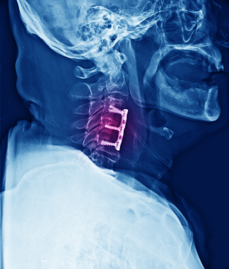 cervical-fusion